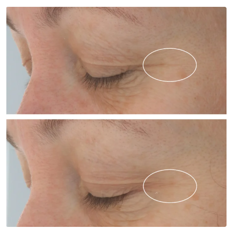 StriVectin Hyaluronic Tripeptide Gel-Cream For Eyes, 0.5 oz, 2-pack